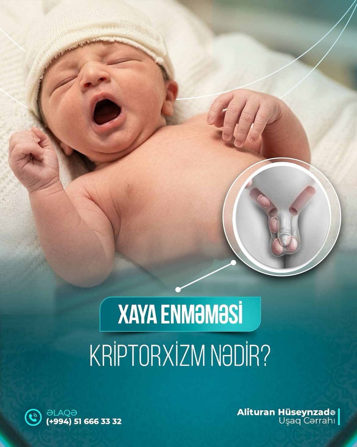 Kriptorxizm nədir və valideynlər nəyə diqqət etməlidir 🔍 Kriptorxizm - oğlan uşaqlarında xayala…