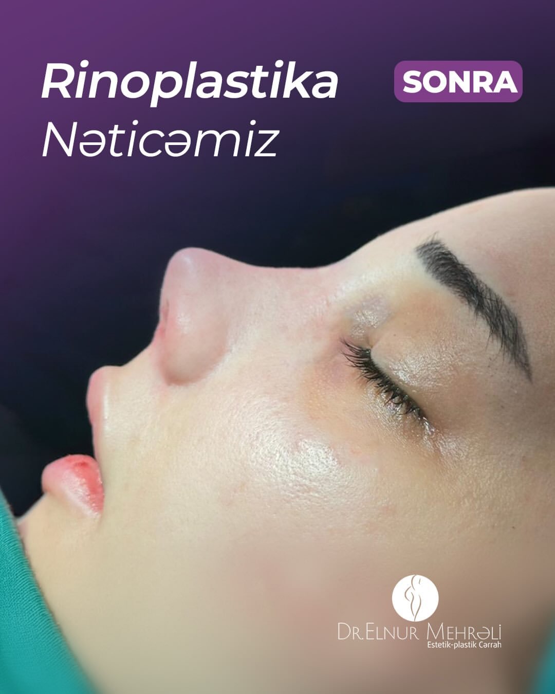 Rinoplastika ilə görünüşünüzdə incə, amma təsirli dəyişiklik edin ✨Proses tam fərdi yanaşma ilə…